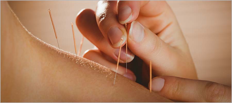 recall-healing-with-acupuncture-in-edmonton:-a-holistic-approach-to-wellness